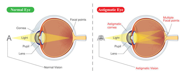 What is an astigmatism: normal eye vs. astigmatic eye infographic