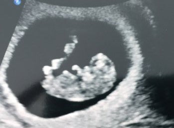 Ultrasound Week Week - What will I at an Early Scan? | EarlyLife