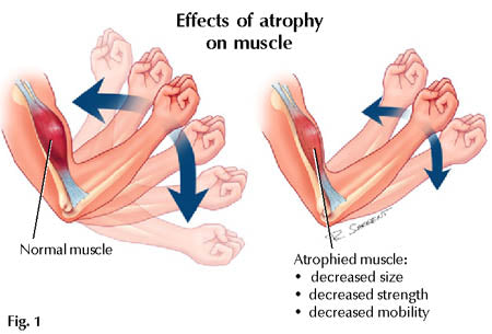 muscle atrophy