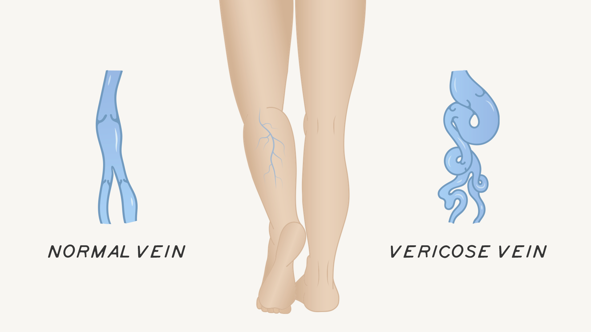 what are varicose veins