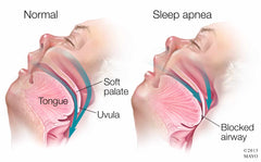 Sleep Apnea