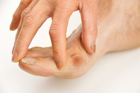 Bunions: Symptoms, Types, and Treatment 03