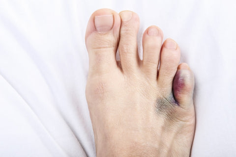 Bunions: Symptoms, Types, and Treatment 04