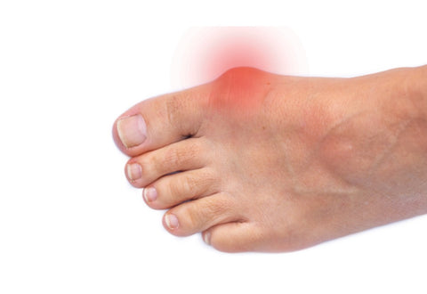 Bunions: Symptoms, Types, and Treatment 05