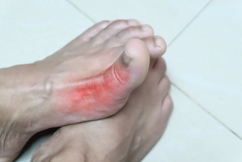 Gout: Symptoms, Causes, Treatment 01