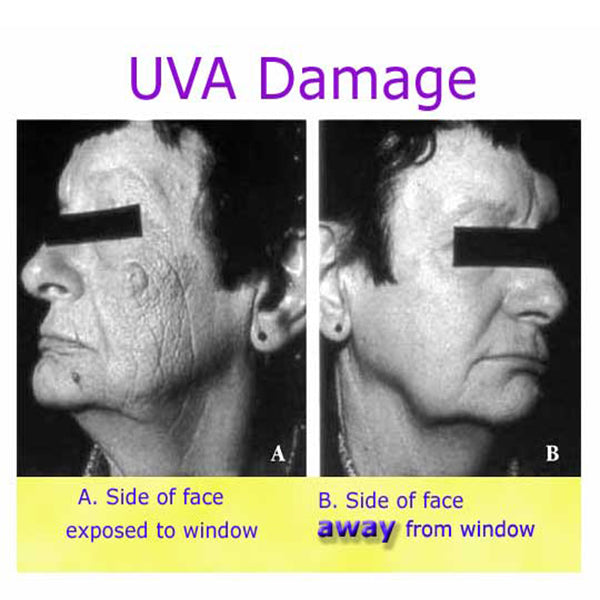 UVA Sun Damage On Left Side Of The Face