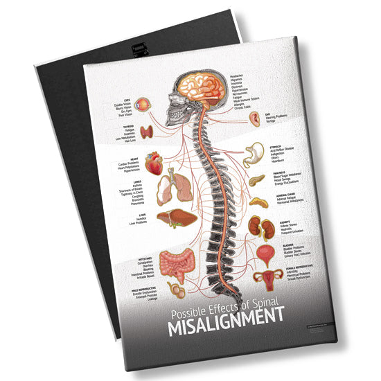 Spine Misalignment Chart Chiropractic Patient Education Poster