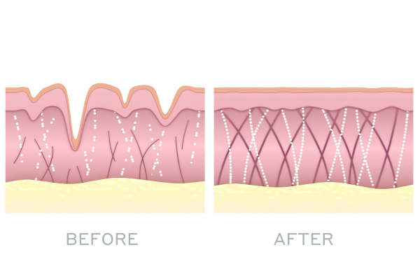 Illustration of skin structure showing before with less collagen fibres and after with more collagen fibres