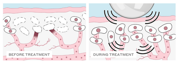 Does microcurrent help treat rosacea? | LiftOff Microcurrent Facial Toning Device | MAGNITONE London