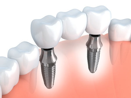 peri implantitis bone implant tooth