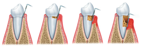 gum disease, periodontal disease, puffy gums, bleeding gums