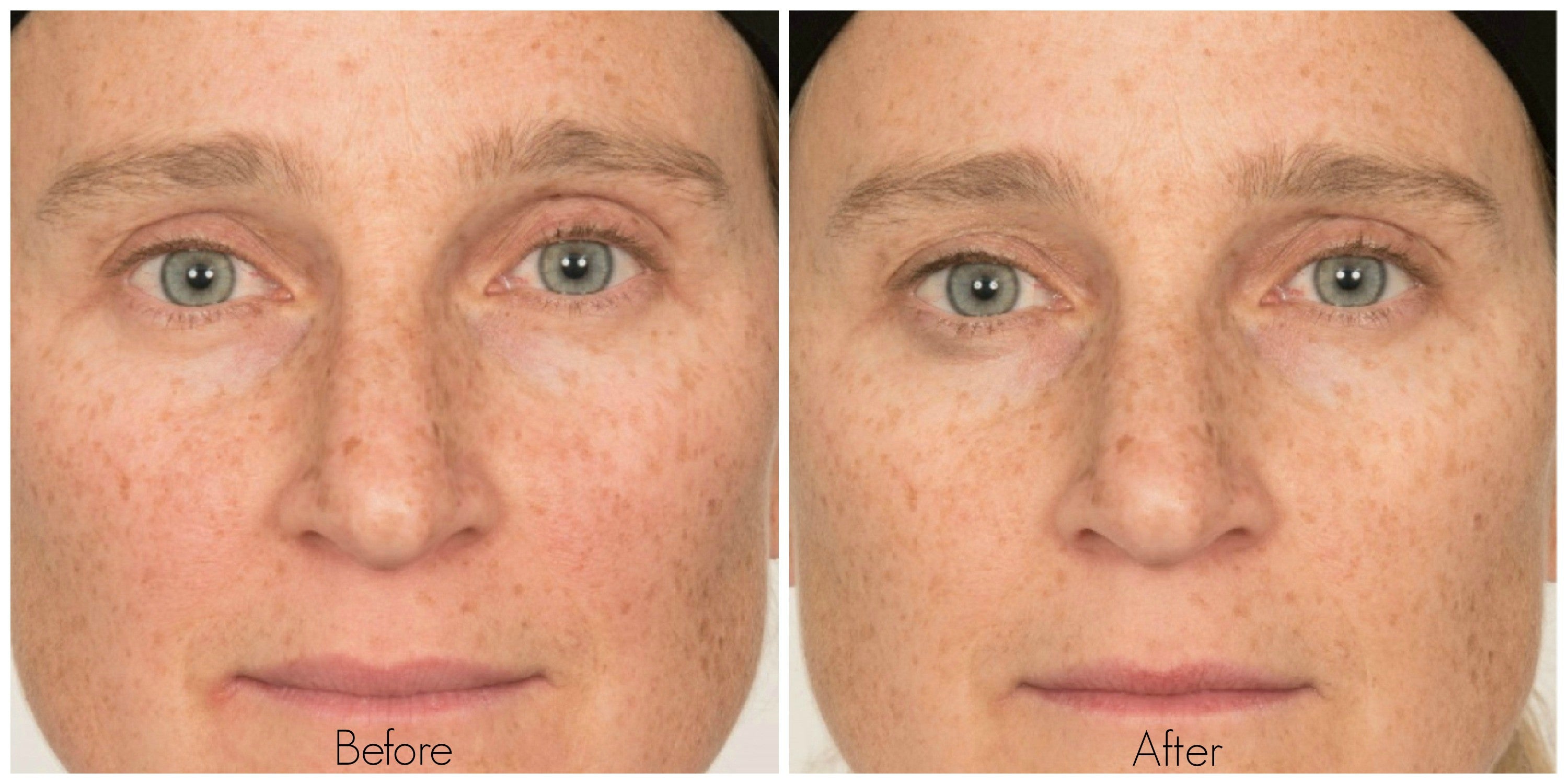 Skin Vitamin C Before And After - NaturalSkins