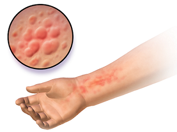 Chlorine Rash And Swimmer’s Itch: Cause, Treatment And Prevention