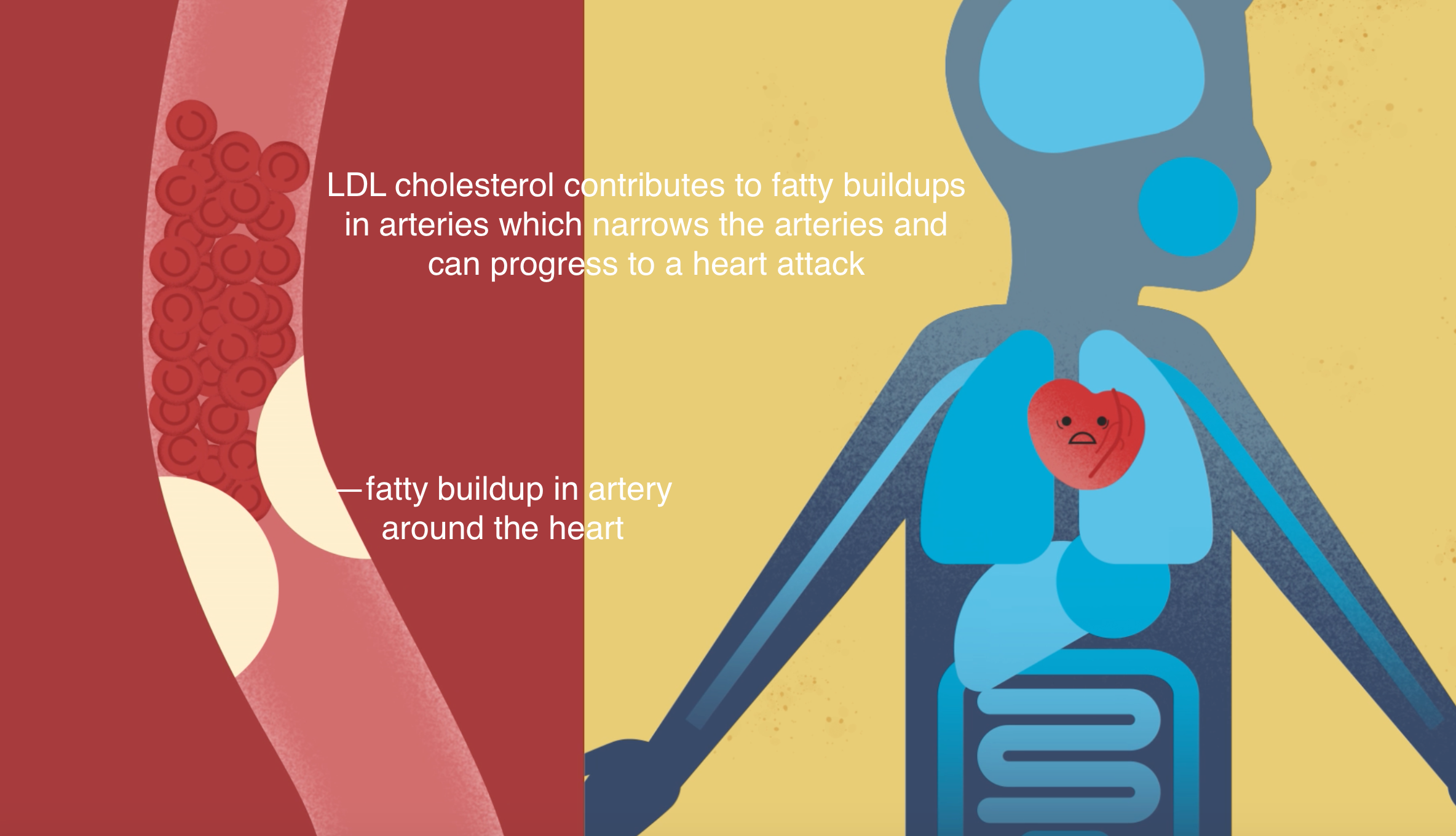 LDL cholesterol fatty buildup in artery around heart