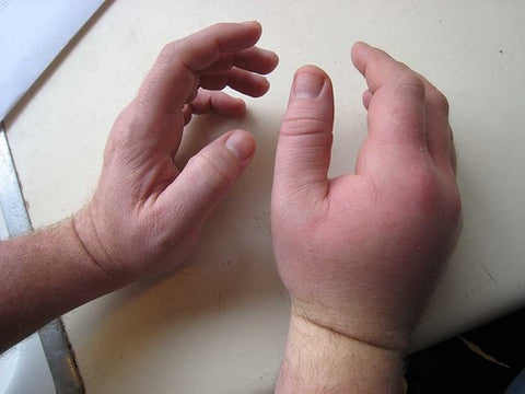 sign and symptoms of allergy to stings
