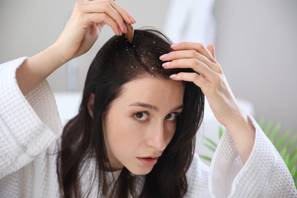 Women with dandruff problem by natural riches