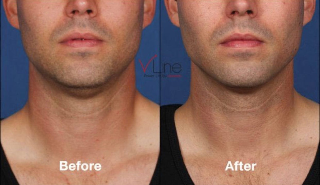 Coolsculpting Double Chin Skin Perfect Brothers Powered By Vla