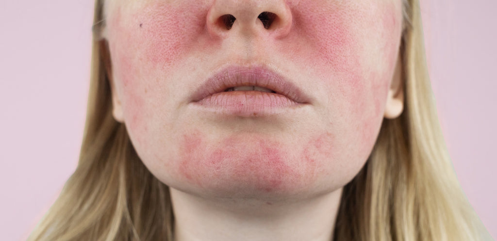The lower half of Caucasian woman's face with rosacea visible on her cheeks and chin, against a pink background.