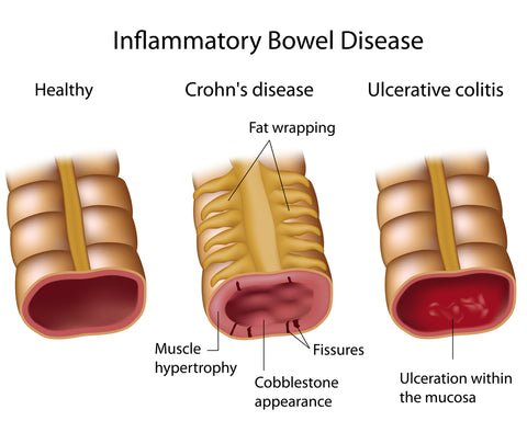 differential diagnosis crohns, ulcerative colitis, IBD