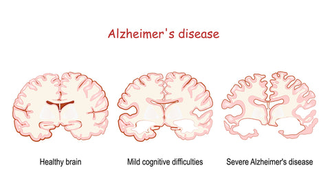 alzheimers disease brain