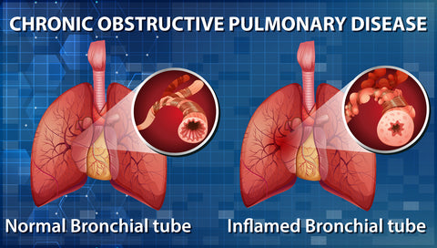 COPD