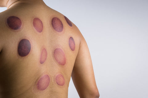 cupping marks