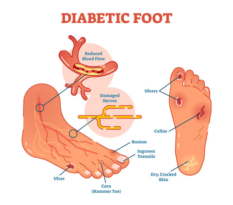 diabetic feet