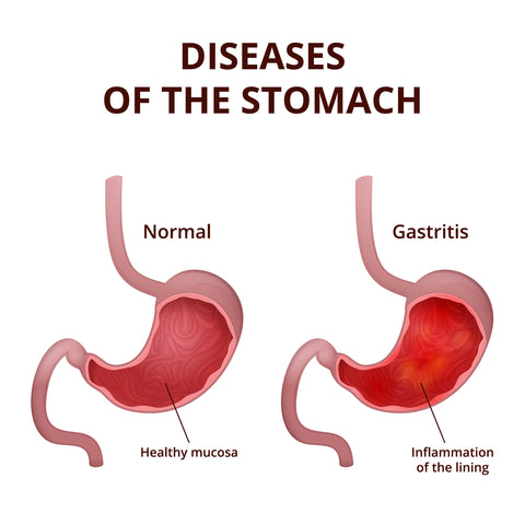gastritis vs normal stomach illustration