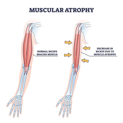 muscular atrophy due to sarcopenia