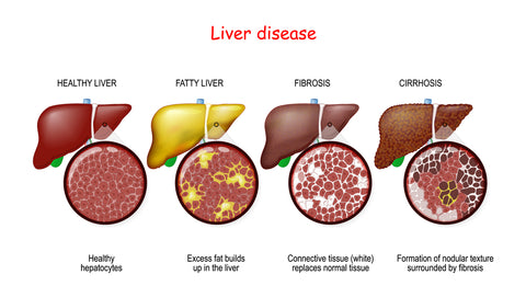 stages of liver disease