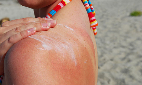 CANNABIS AND CBD FOR SUNBURN