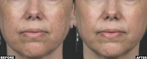 Non Ablative Resurfacing laser before and after