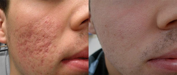 NonAblative Resurfacing Laser