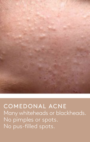 A comedonal acne example of a person's cheek with many whiteheads or blackheads.