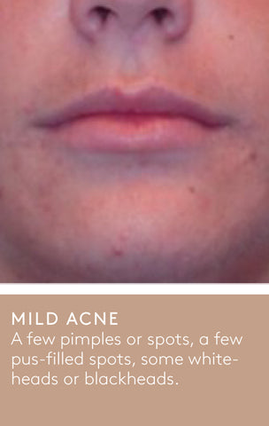 A mild acne example showing the lower half of a person's face with a few pimples or spots, a few pus-filled spots and some whiteheads or blackheads