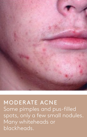 A moderate acne example showing the lower half, right side of a person's face with some pimples and pus-filled spots but only a few small nodules and many whiteheads and blackheads