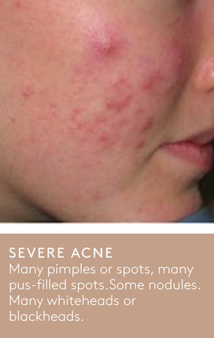 A severe acne example showing the right side of a person's face with many pimples and spots, some nodules and many whiteheads and blackheads