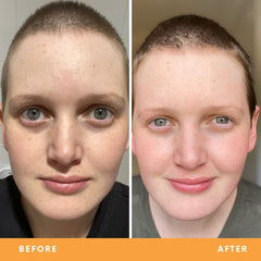 Before After photo of Sharna's congested skin, left image, Sharna's face with oily and dull skin texture, right image, her skin looks more vibrant, smooth & calm