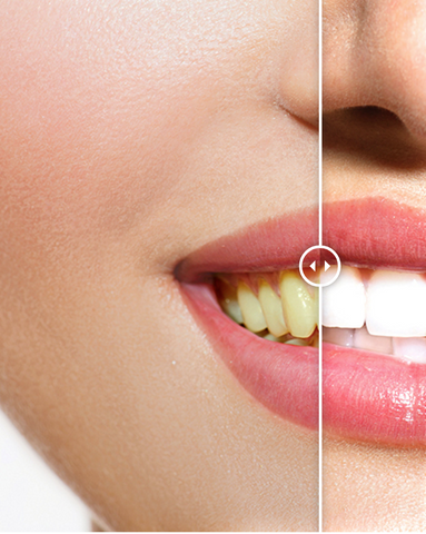best teeth whitening products buzzfeed