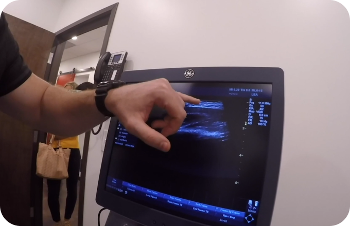 Ultrasound Fascia Remodeling
