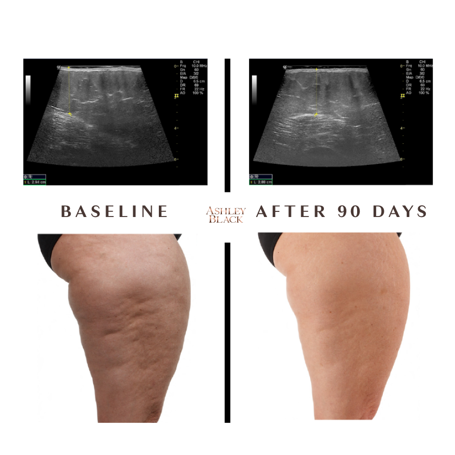 Ultrasound Cellulite