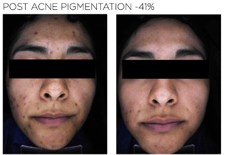 Post acne pigmentation