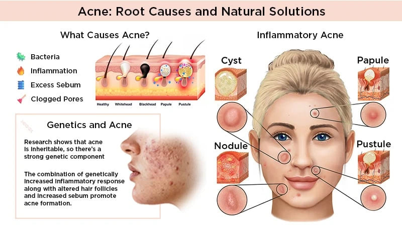 Acne Infographic.webp__PID:ee7d9703-e2d9-4e59-a55c-4c9a849e71db