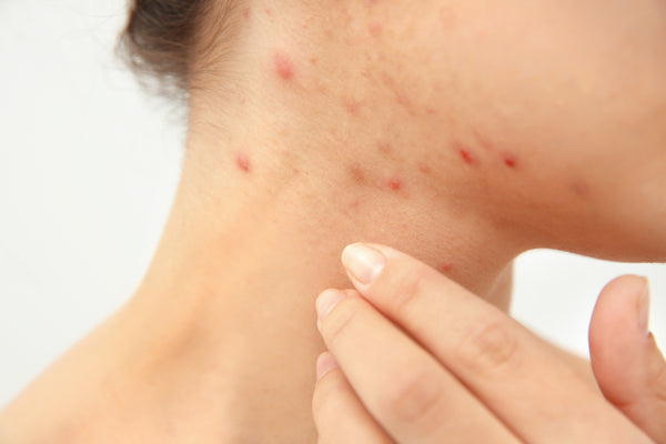 What Causes Hormonal Acne? Is it My Fault