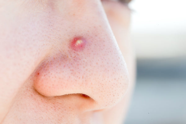 acne cyst nose