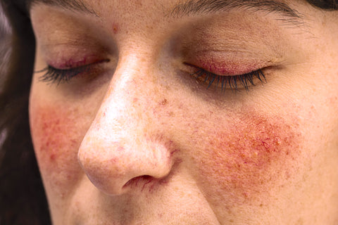 Ocular rosacea can affect your eyes and eyelids