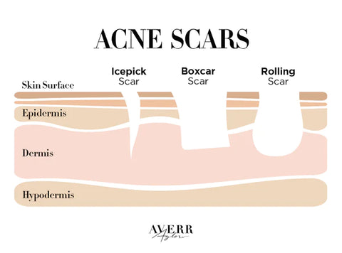 Five Types of Acne Scars