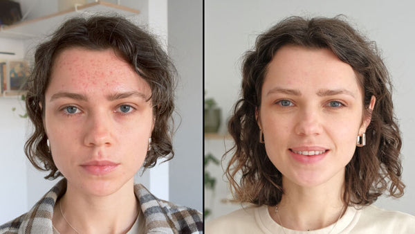 Averr Aglow Acne Scars