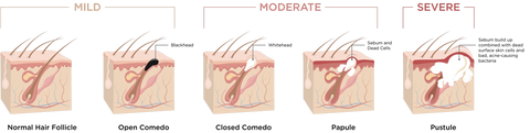 Averr Aglow® Types of Acne