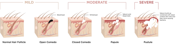 Averr Aglow® Types of Acne